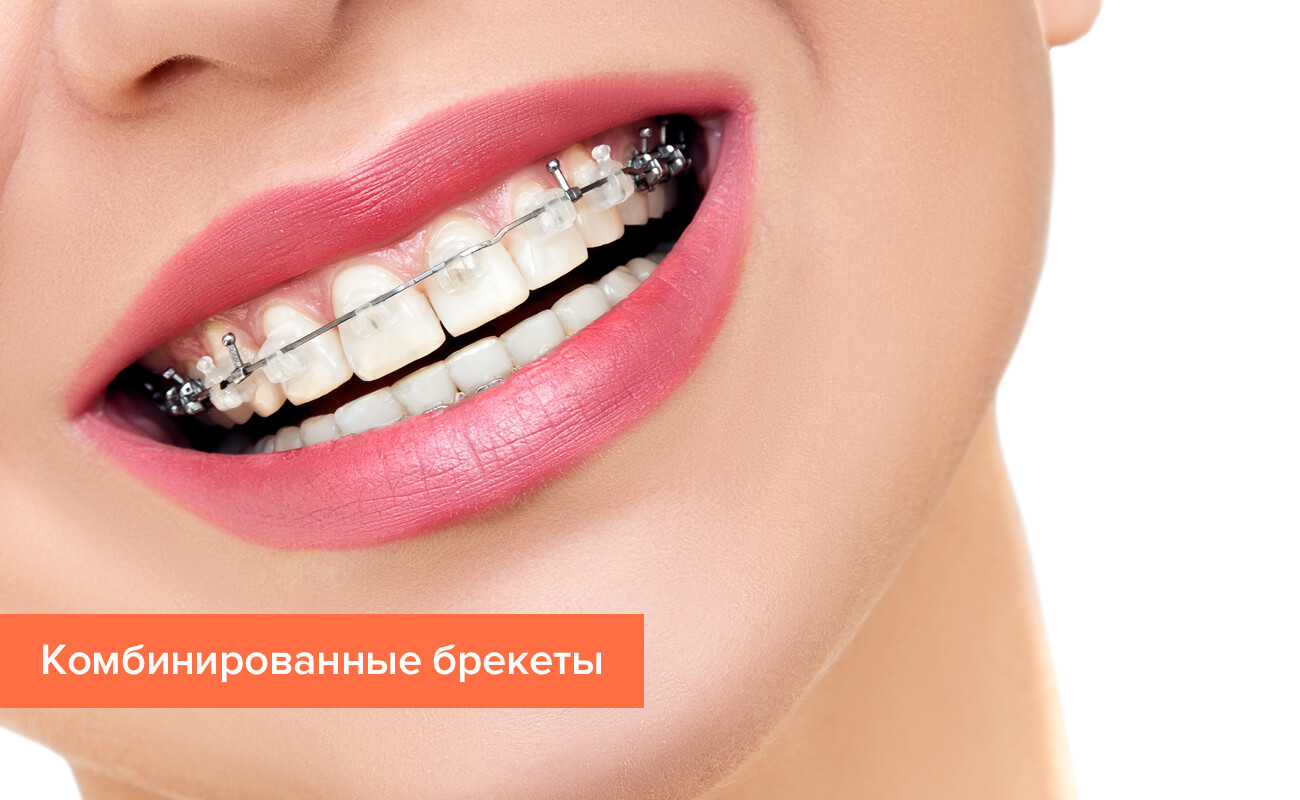 Фото комбинированных брекетов на зубах