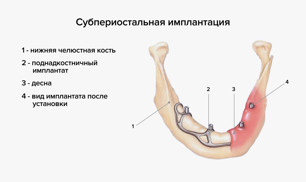 Субпериостальная имплантация в картинках