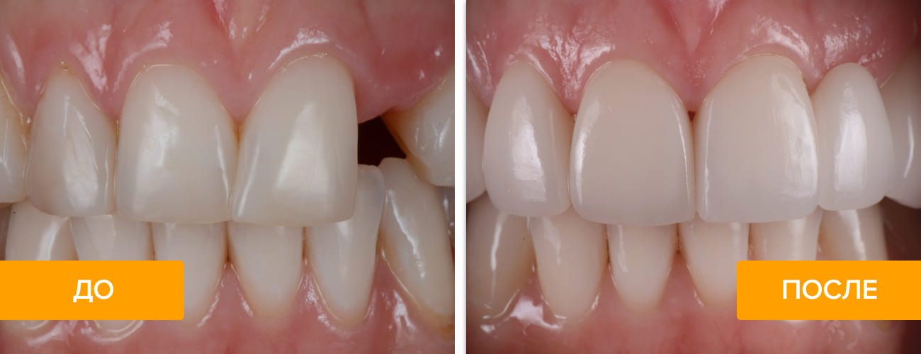 Фото пациента до и после установки импланта зуба на верхнюю челюсть