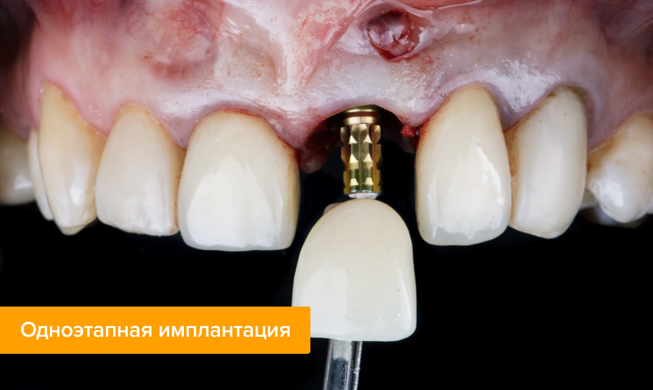 Для чего нужны временные коронки при имплантации. Смотреть фото Для чего нужны временные коронки при имплантации. Смотреть картинку Для чего нужны временные коронки при имплантации. Картинка про Для чего нужны временные коронки при имплантации. Фото Для чего нужны временные коронки при имплантации