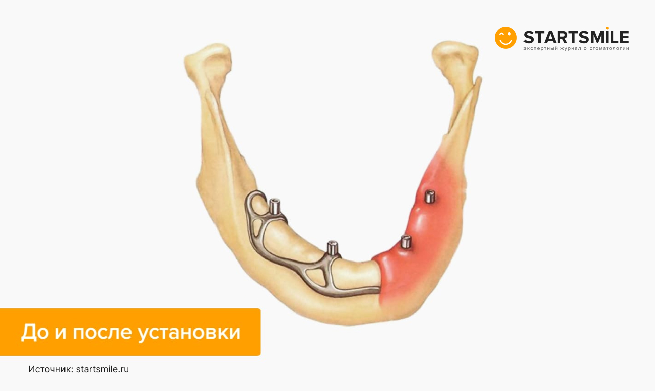 До и после установки субпериостального импланта в картинках.