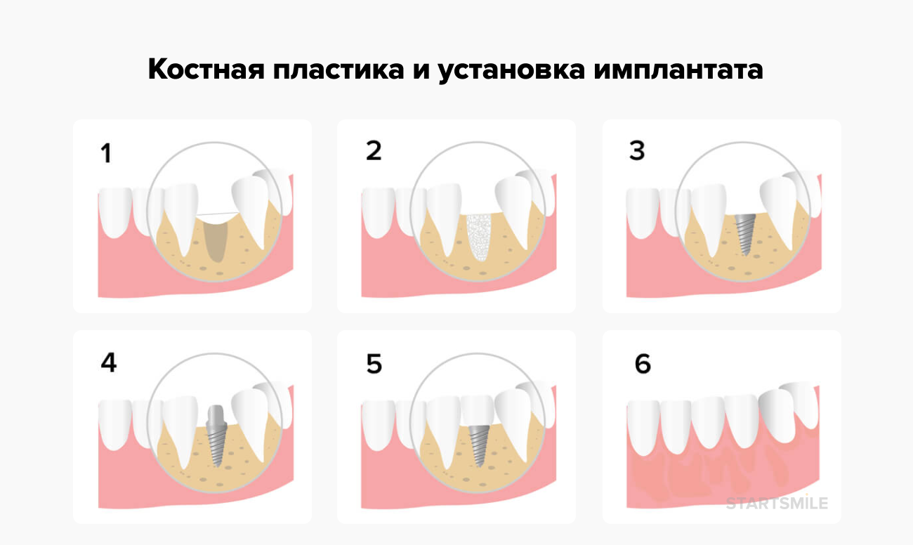 Синус десны. Костная пластика в стоматологии. Остеопластика в стоматологии. Удаление зуба и установка импланта. Установка импланта с наращиванием кости.