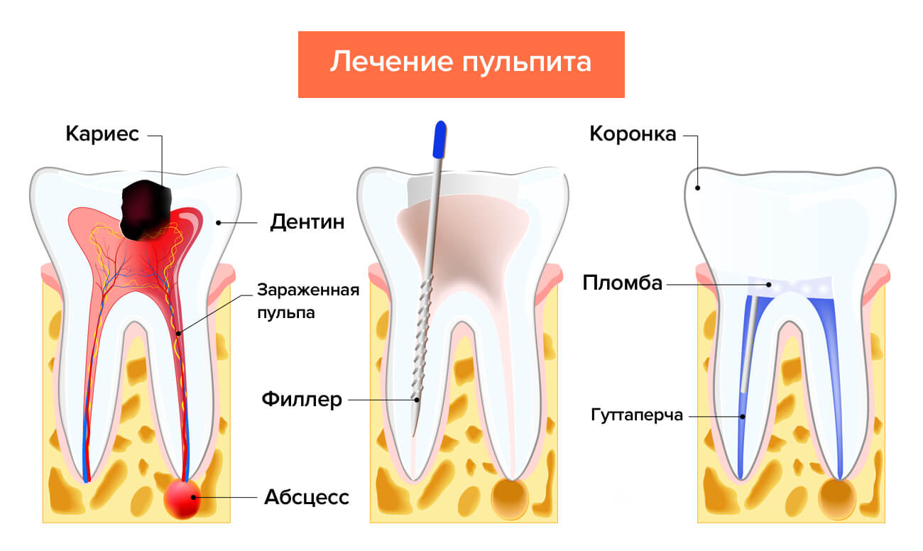 Лечение пульпита в картинках