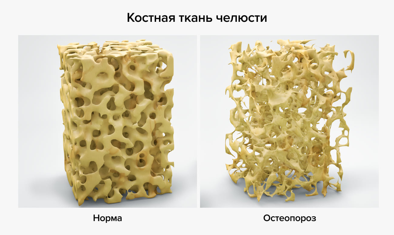 Костная ткань челюсти: норма и остеопороз в картинках