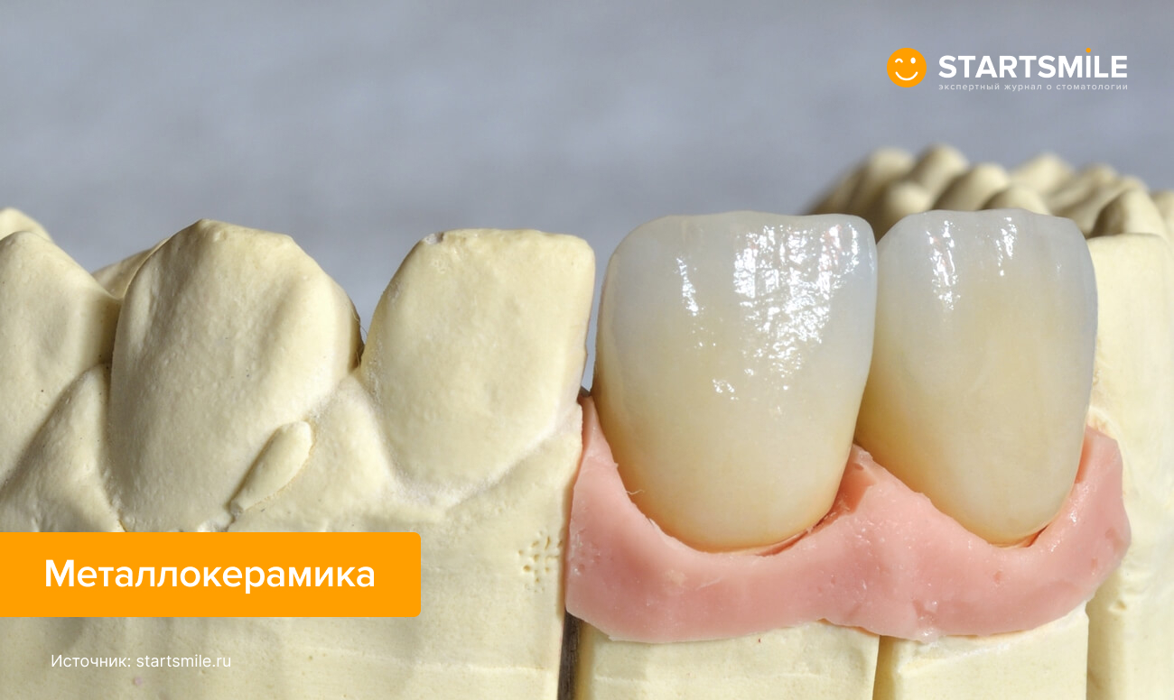 Фото металлокерамической коронки на импланте в искусственной челюсти.