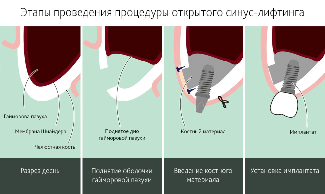 Презентация закрытый синус лифтинг