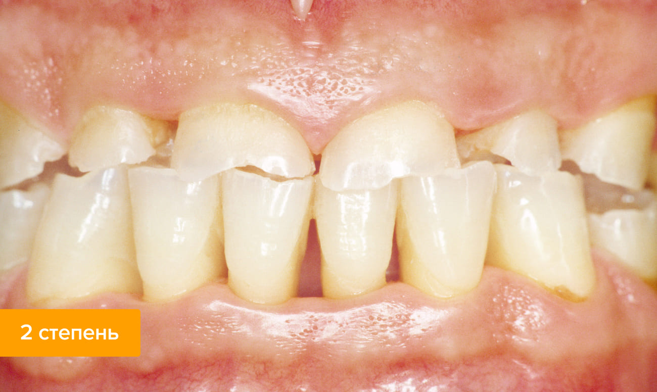 Фото второй степени стираемости зубов