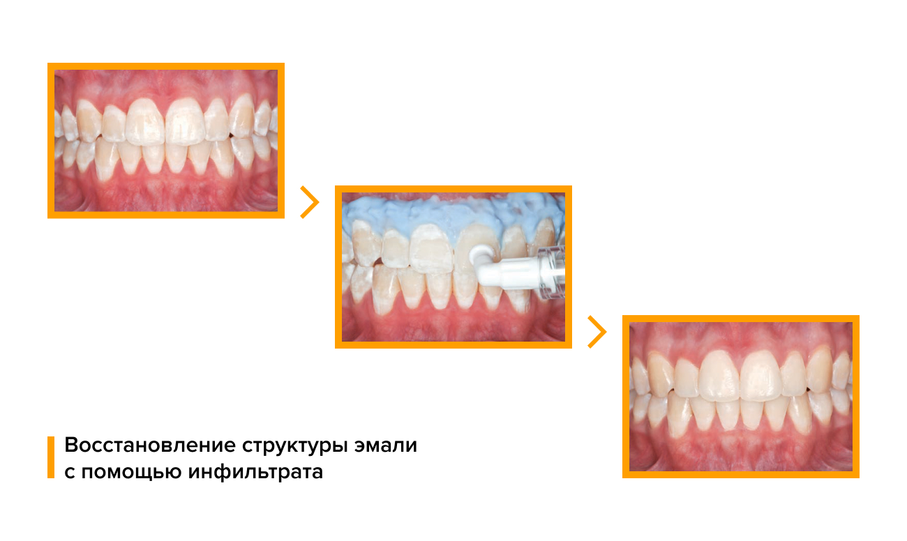 Восстановление структуры эмали с помощью инфильтрата в фотографиях.