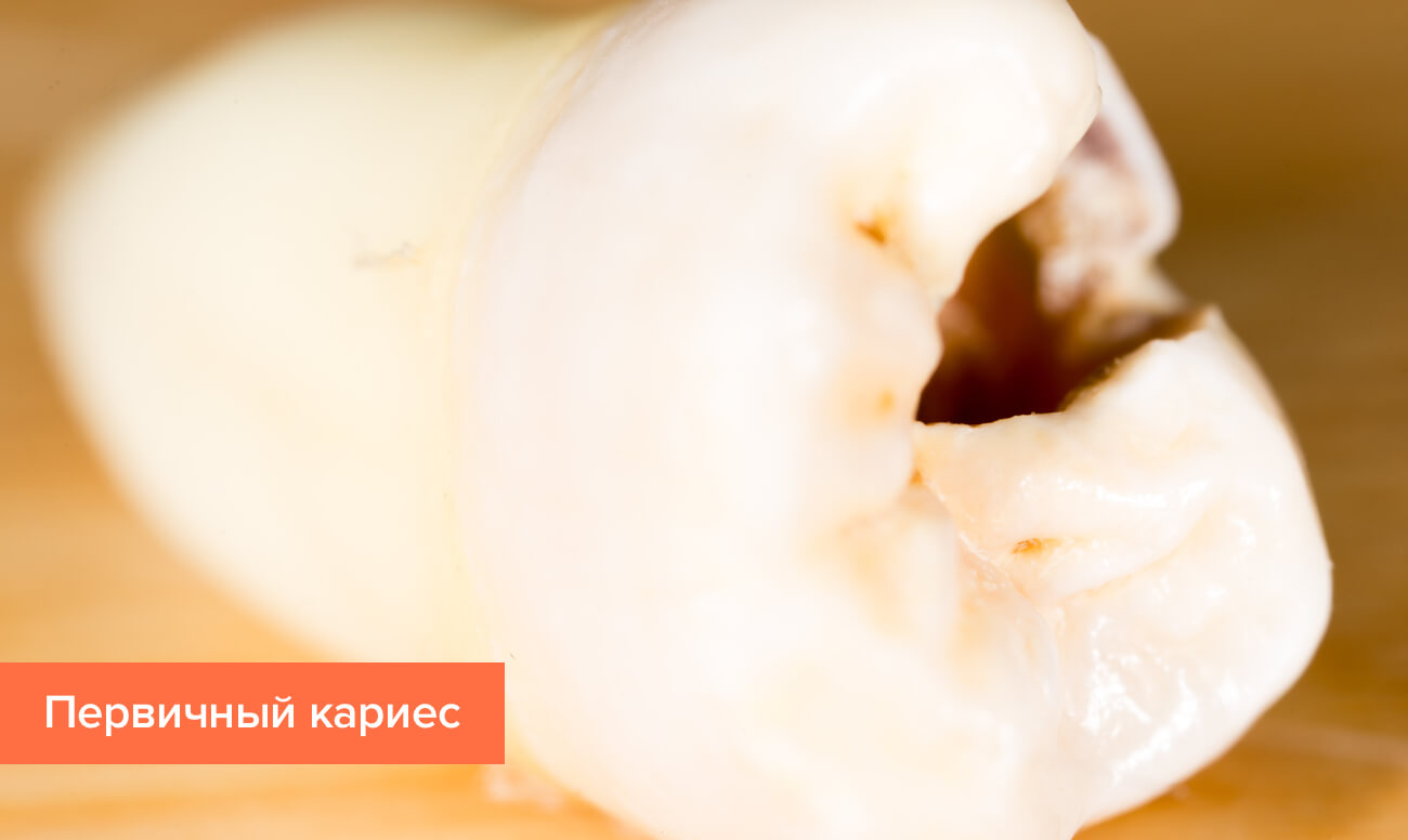 Кариес небольшая дырка