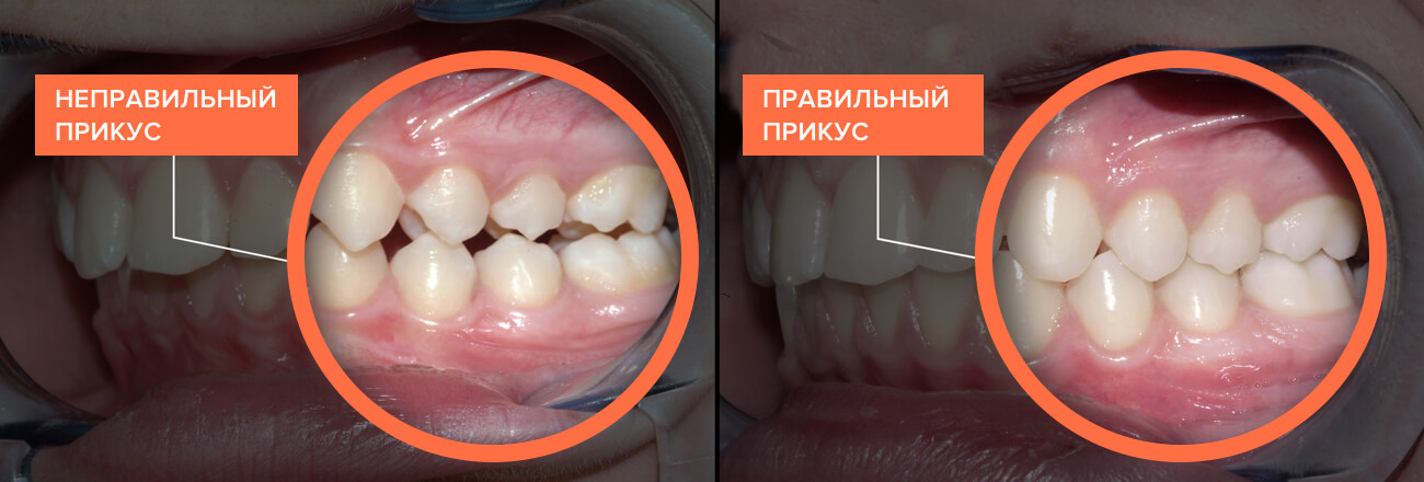 Варианты смыкания зубов в боковых отделах