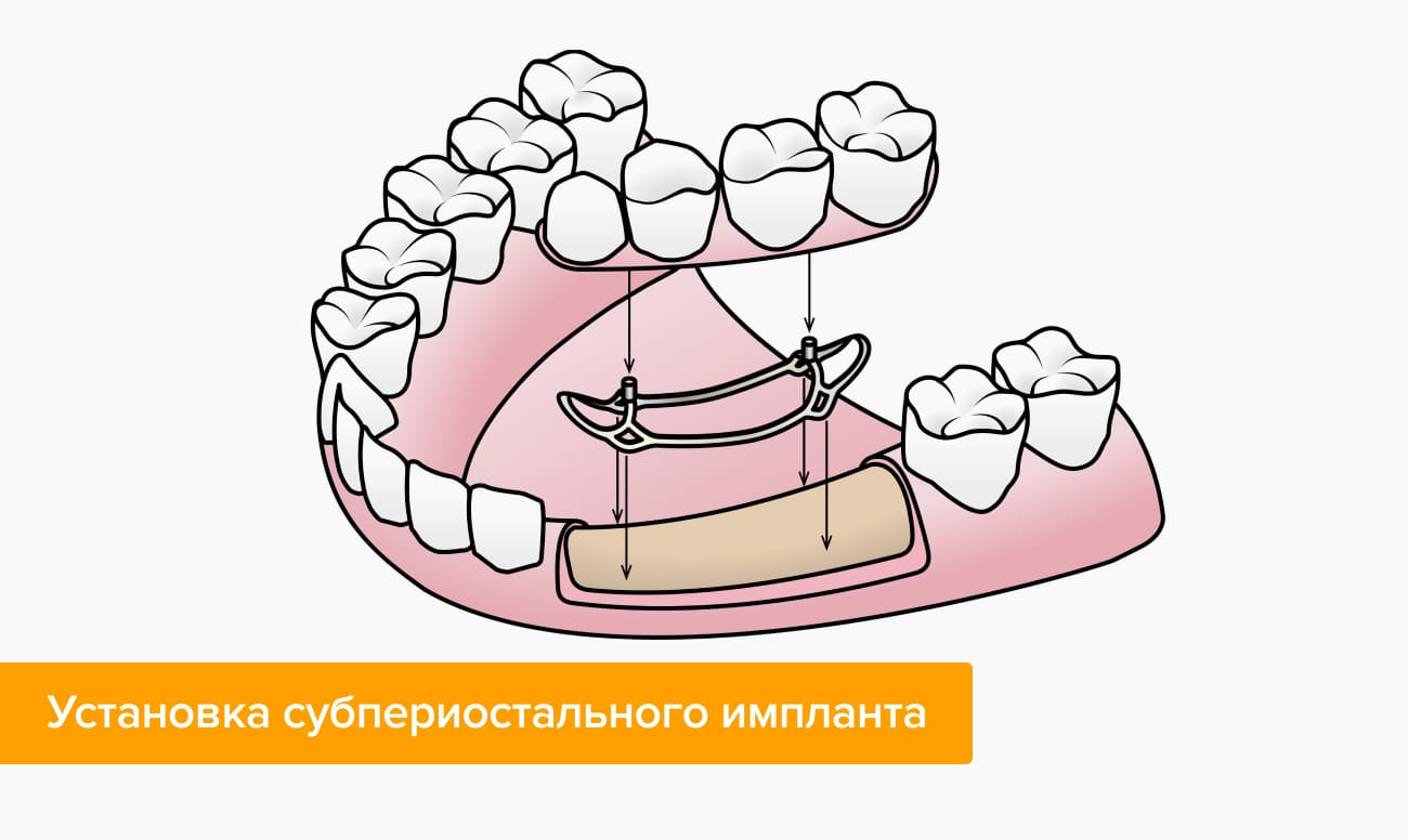 субпериостальная имплантация что это. Смотреть фото субпериостальная имплантация что это. Смотреть картинку субпериостальная имплантация что это. Картинка про субпериостальная имплантация что это. Фото субпериостальная имплантация что это