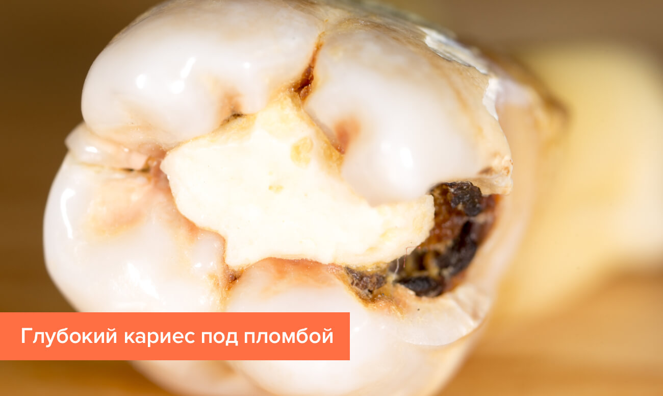 Фото глубокого кариеса под пломбой