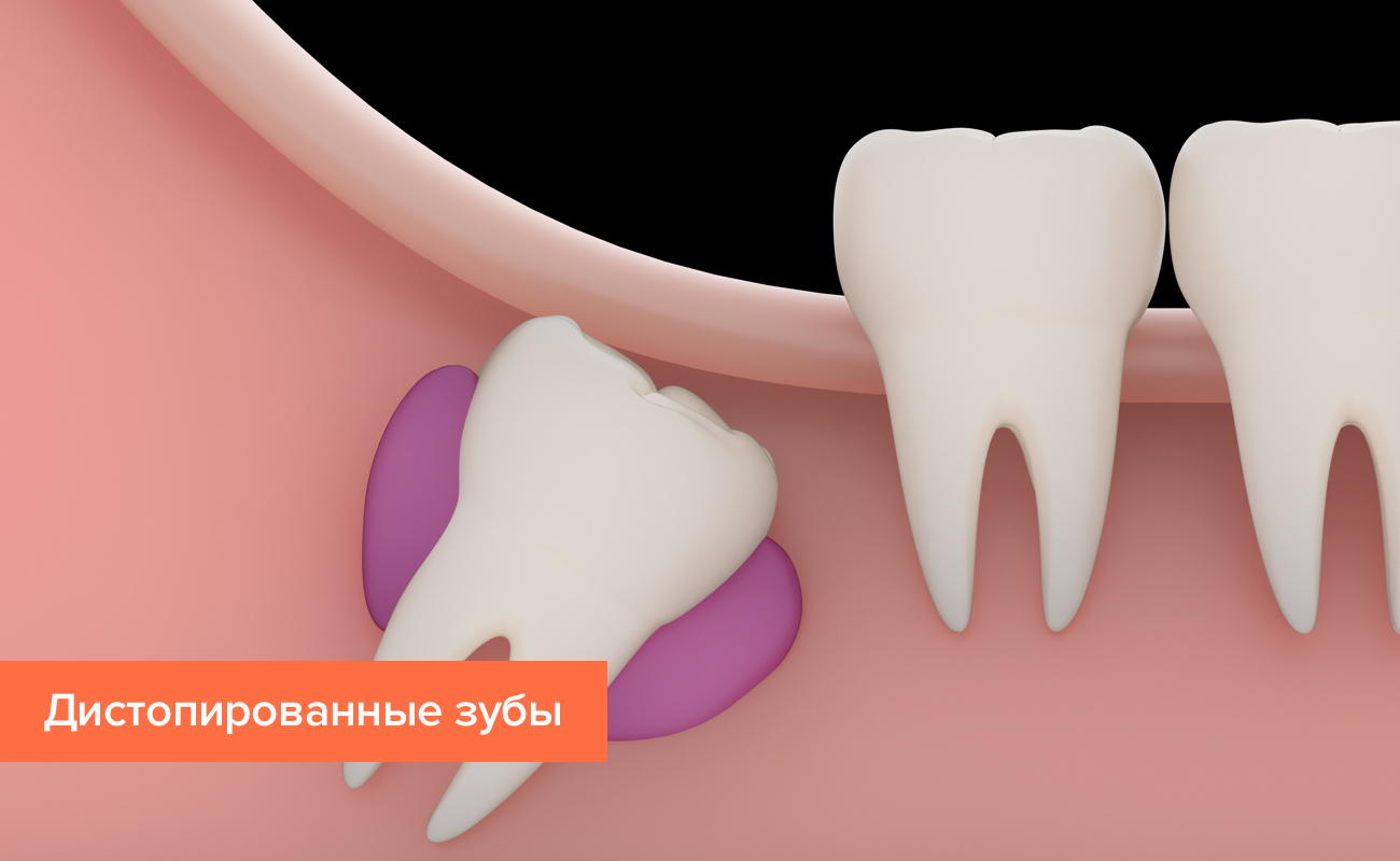 Кариес Зубов Реферат Кариес Зубов Реферат
