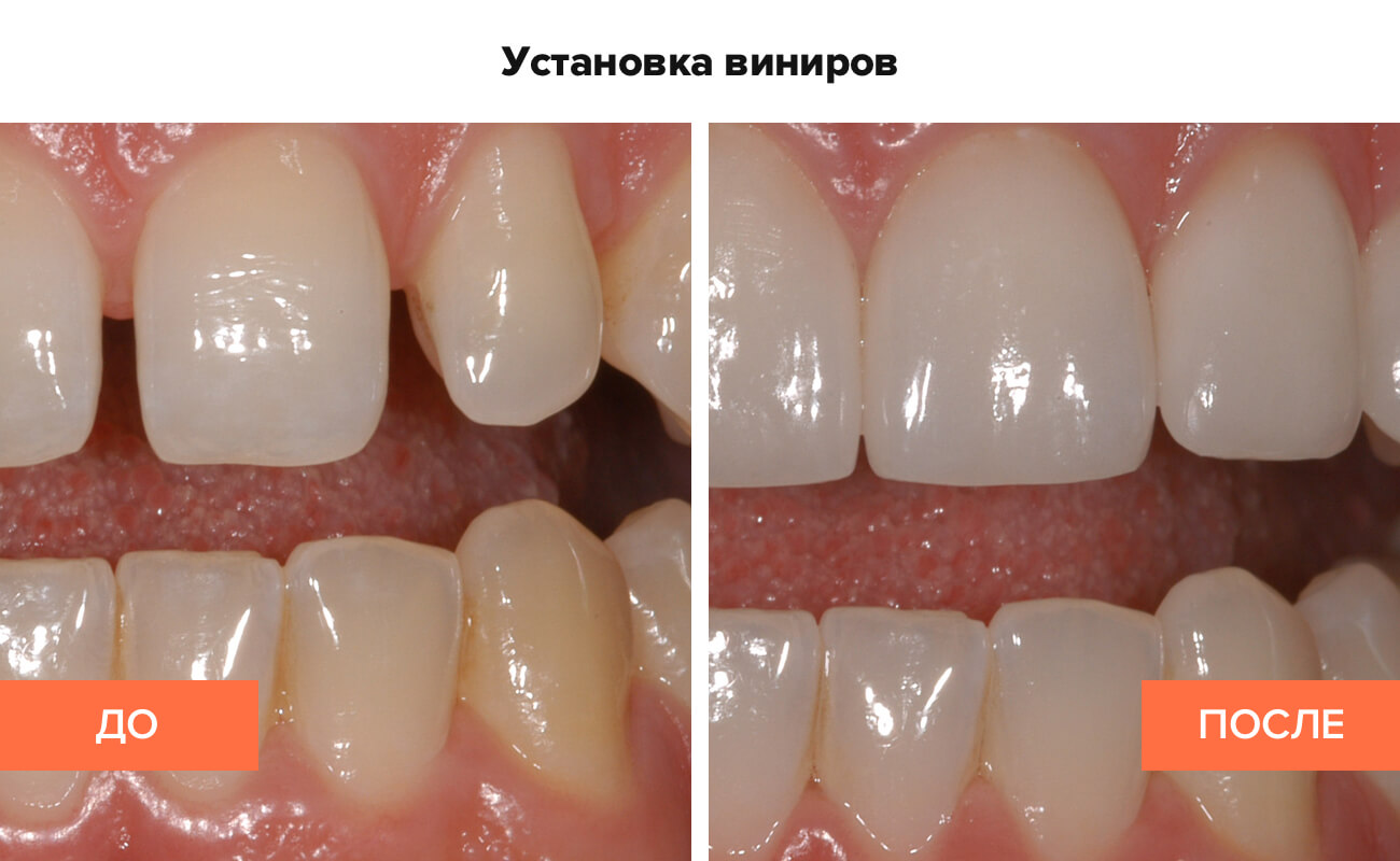  Фото пациента до и после установки виниров