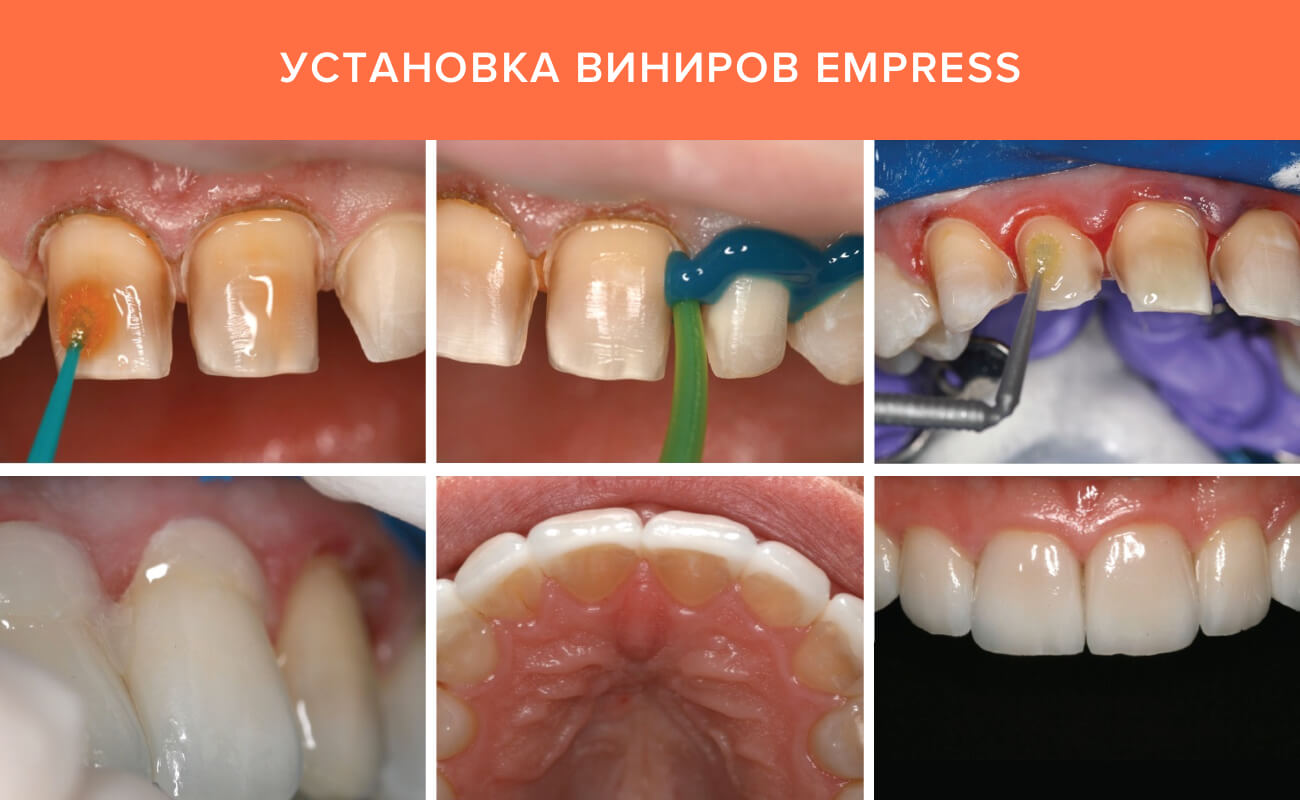 Этапы установки виниров Empress Фото этапов установки виниров Empress