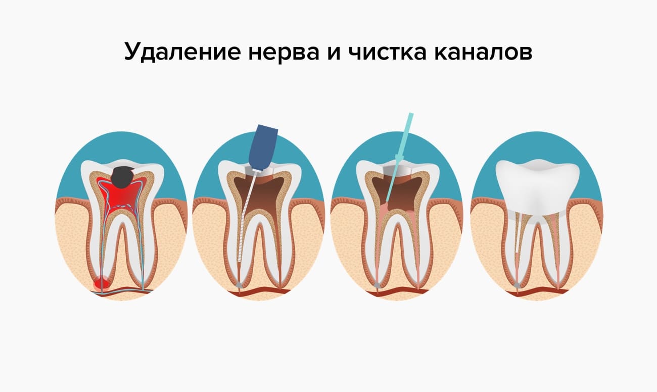 После удаления нерва болит зуб при постукивании