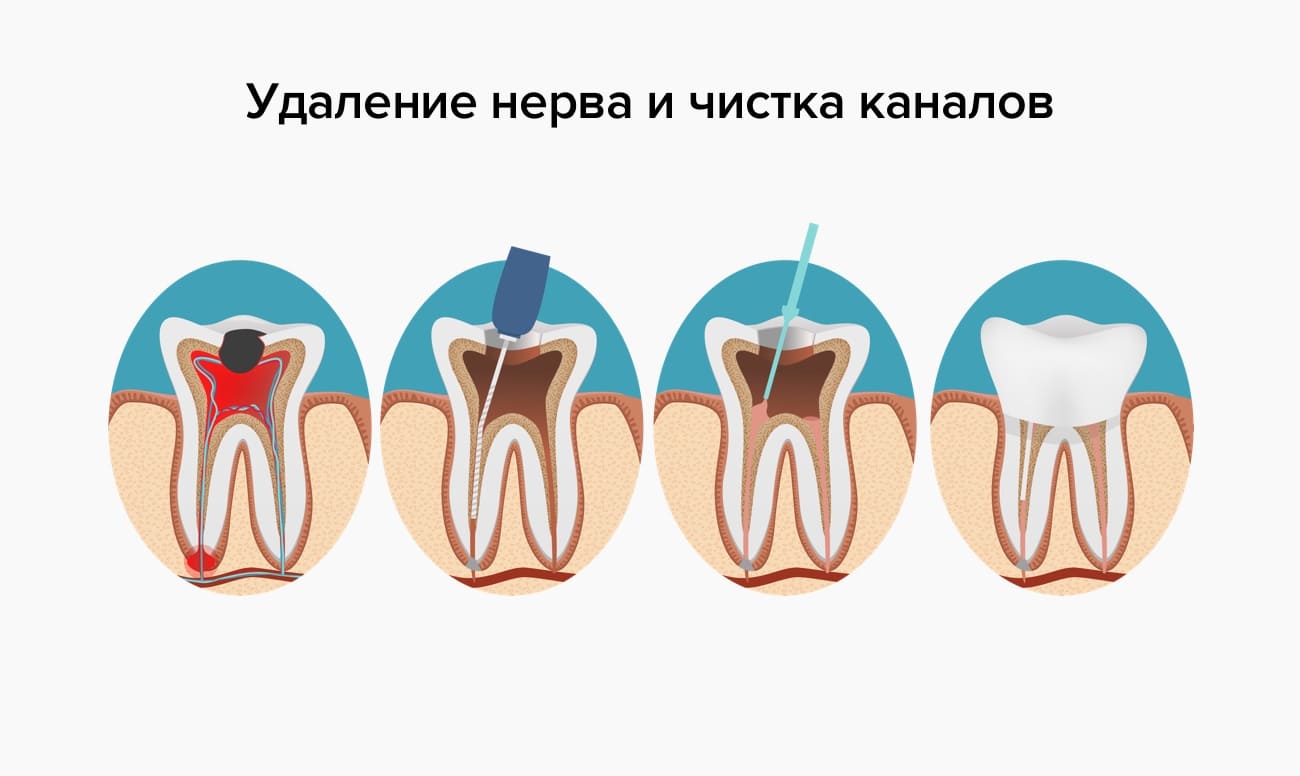 Удаление нерва и чистка каналов в картинках