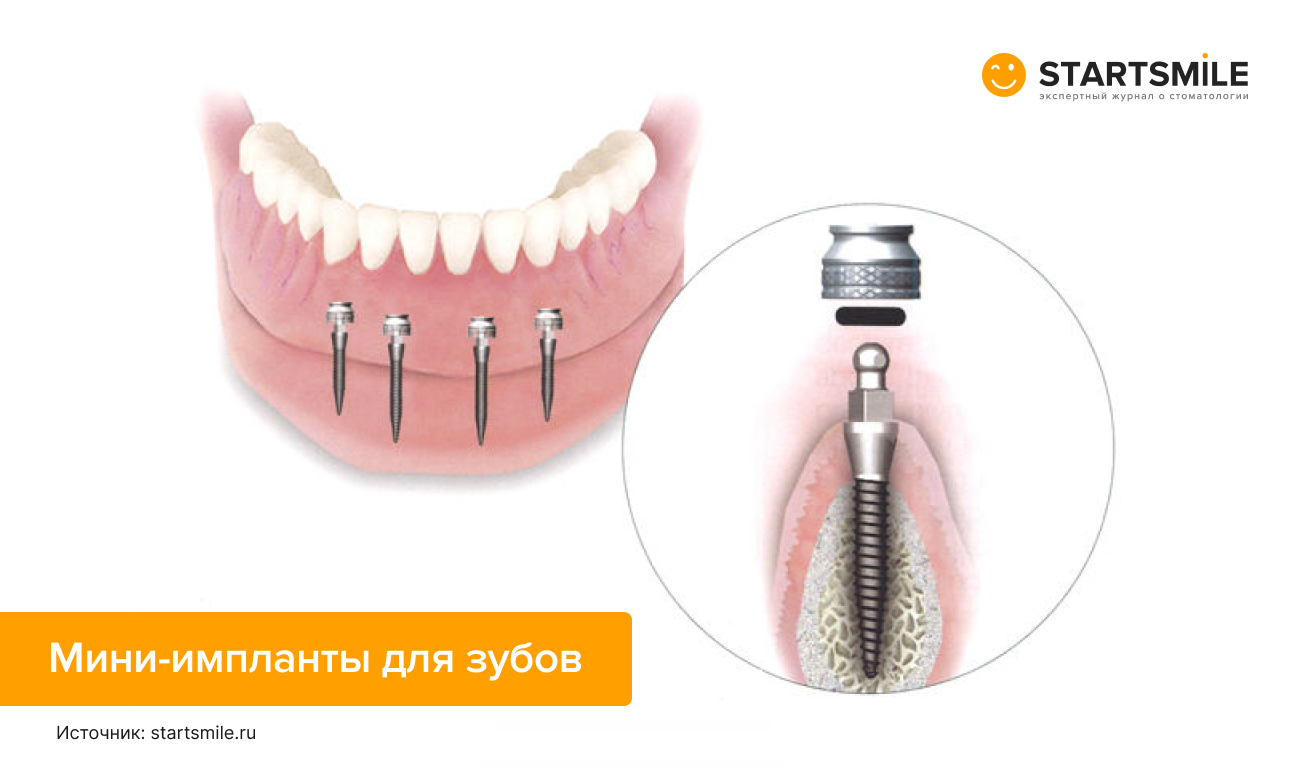 Мини-импланты зубов, в том числе в челюсти, в картинках.