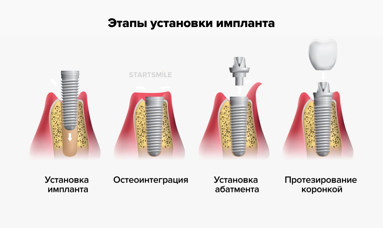 Этапы установки импланта зуба в картинках.
