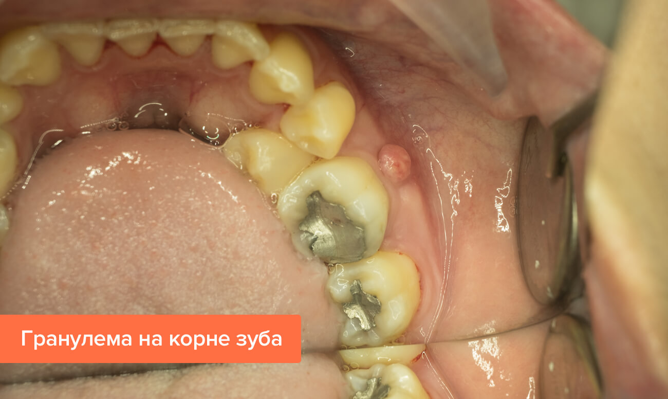 Фото гранулемы на корне зуба
