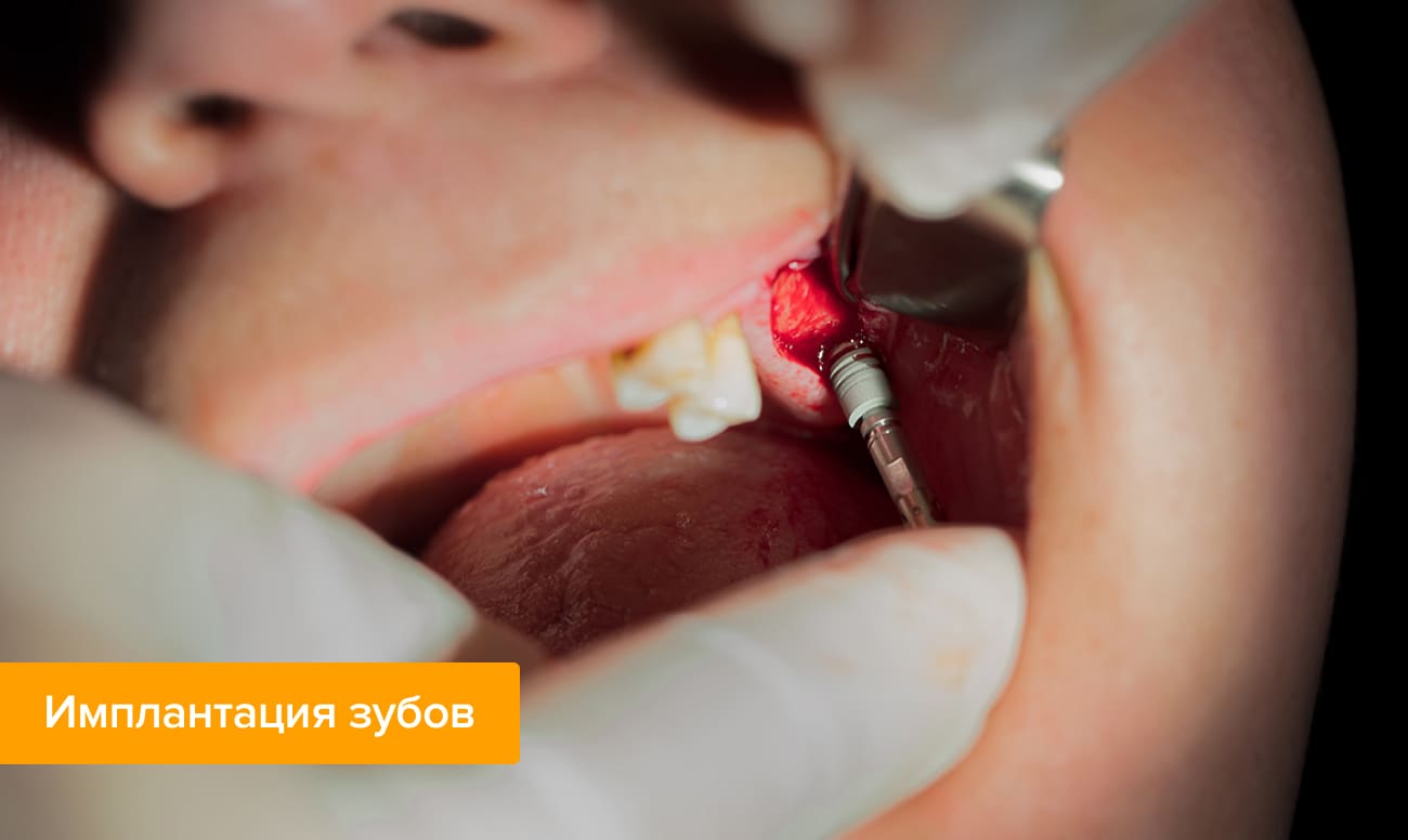 Фото процесса имплантации зубов