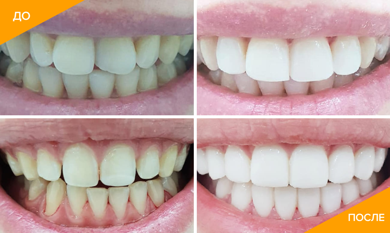 Фото зубов до и после установки люминиров