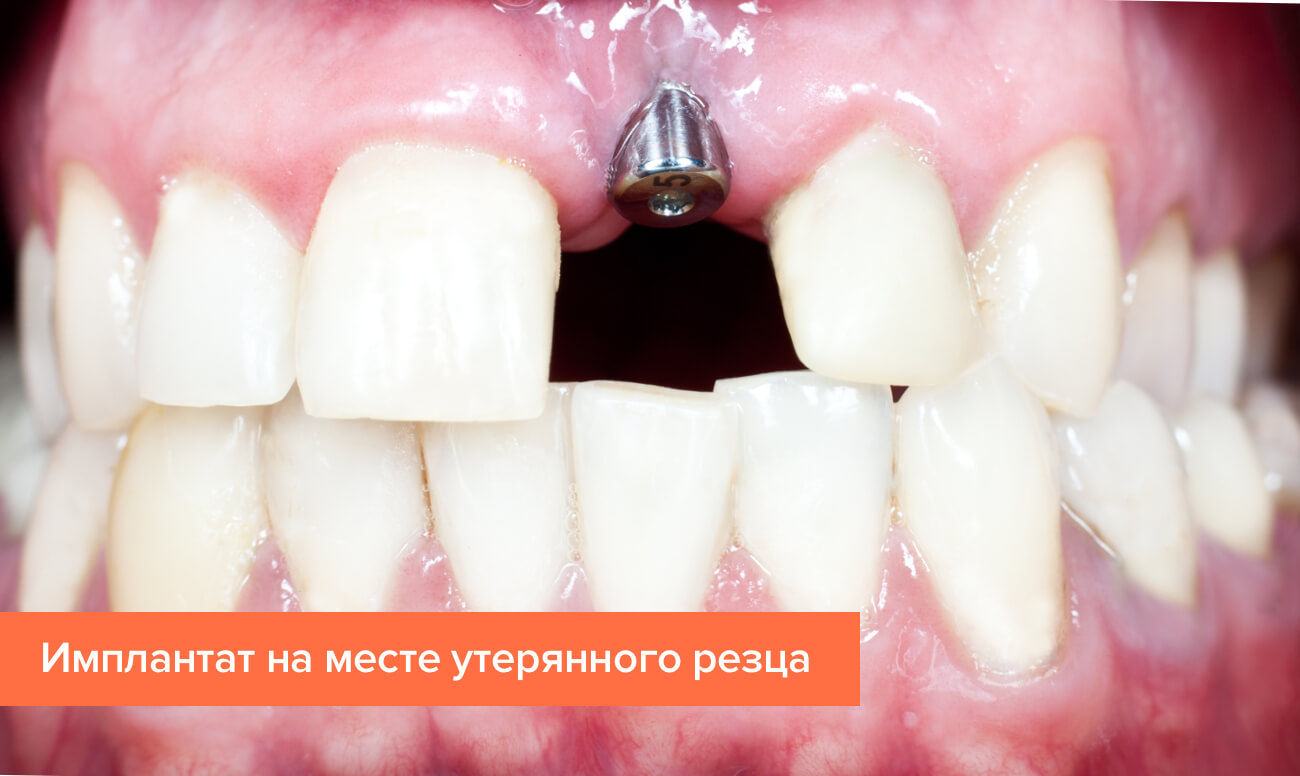 Имплантат на месте утерянного резца Фото имплантата на месте утерянного резца