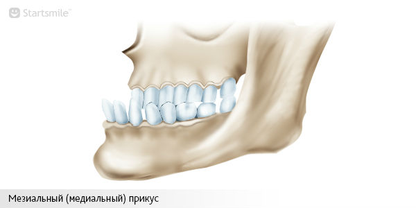 Мезиальный (медиальный) прикус