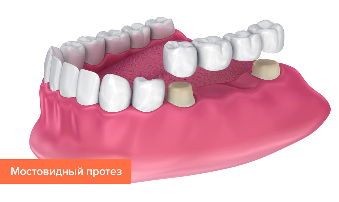 Мостовидный протез зубов в картинках