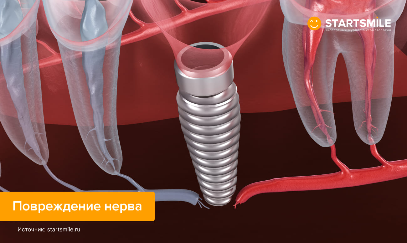 Повреждение нерва имплантом в картинках