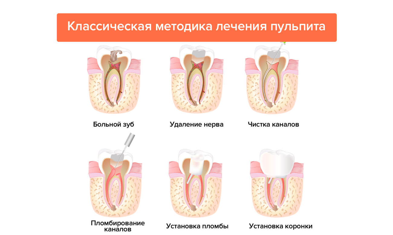 Удаление каналов в зубе