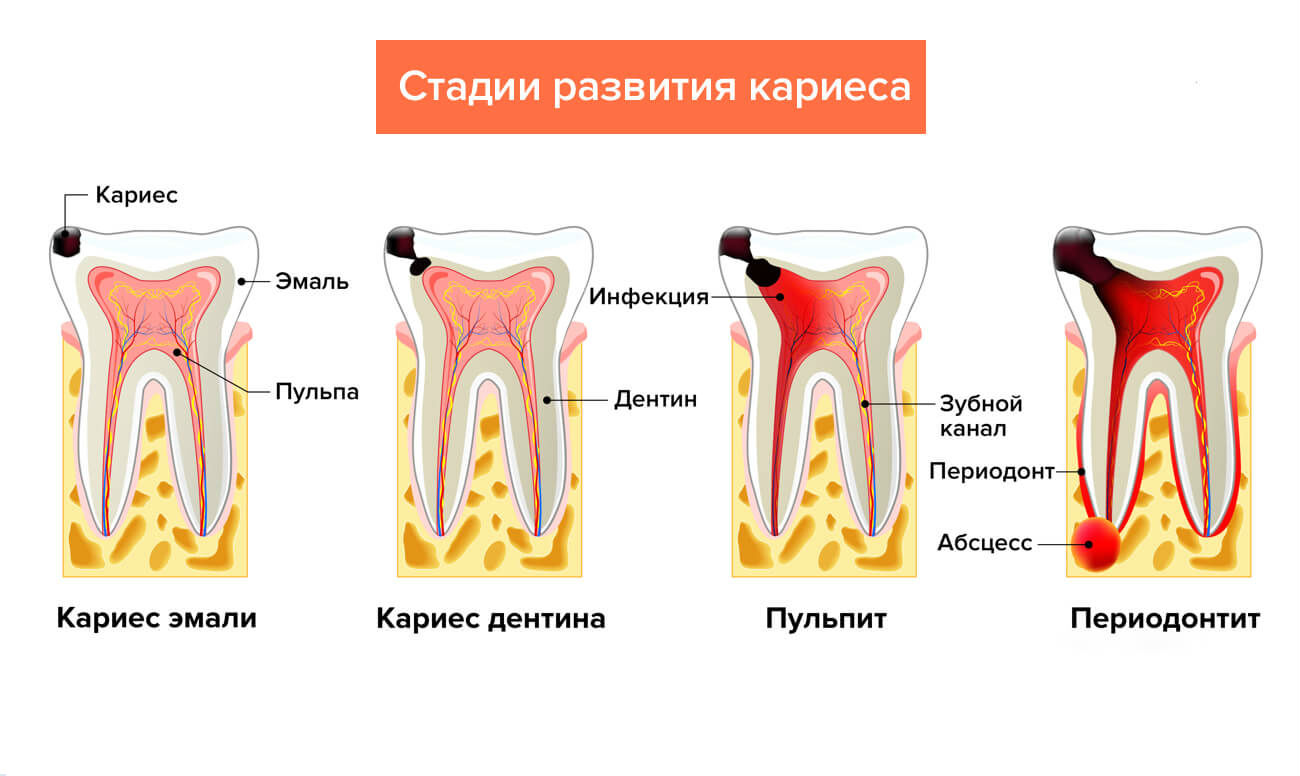 Стадии развития кариеса в картинках