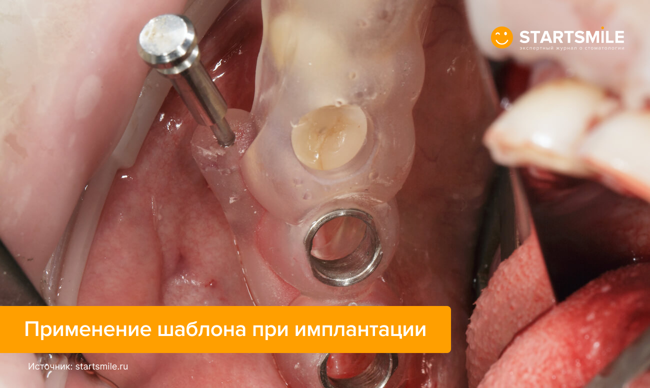 Фото применения хирургического шаблона во время операции по имплантации зубов.