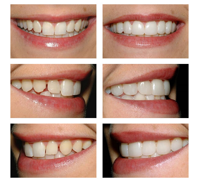 Фото до и после установки ультраниров на зубы