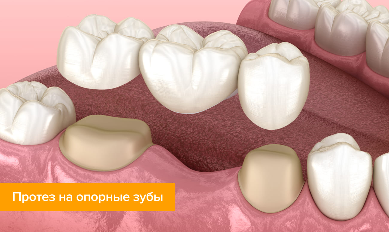 Протез на опорные зубы в картинках