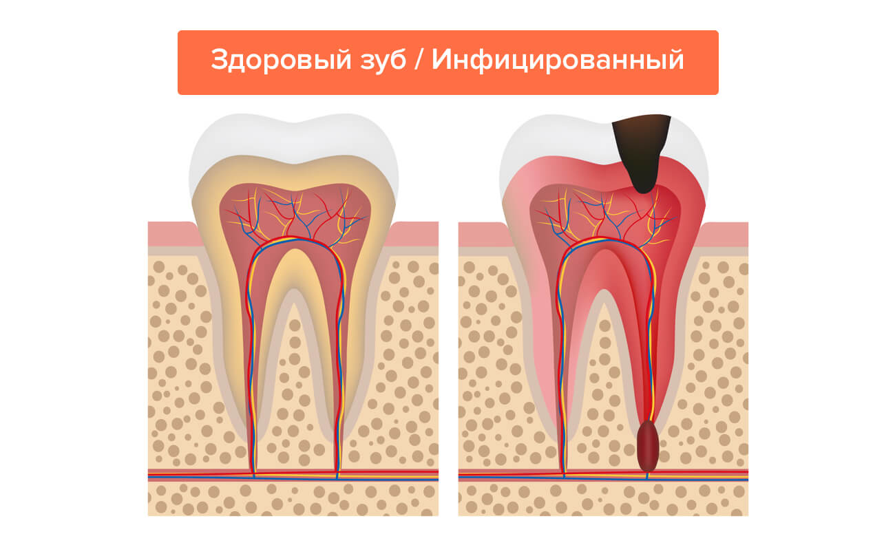 Здоровый и инфицированный зуб в картинках