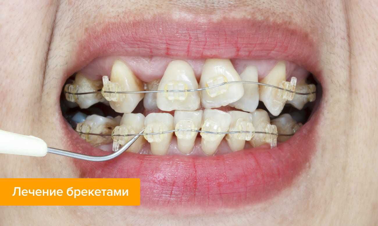 Фото брекетов на зубах во время лечения