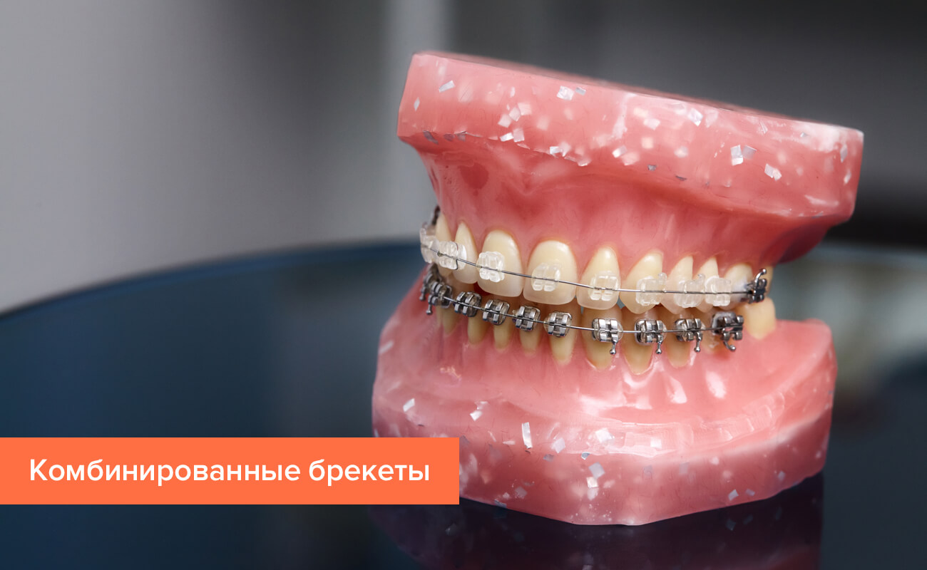 Комбинированные брекеты на зубах Фото комбинированных брекетов на зубах