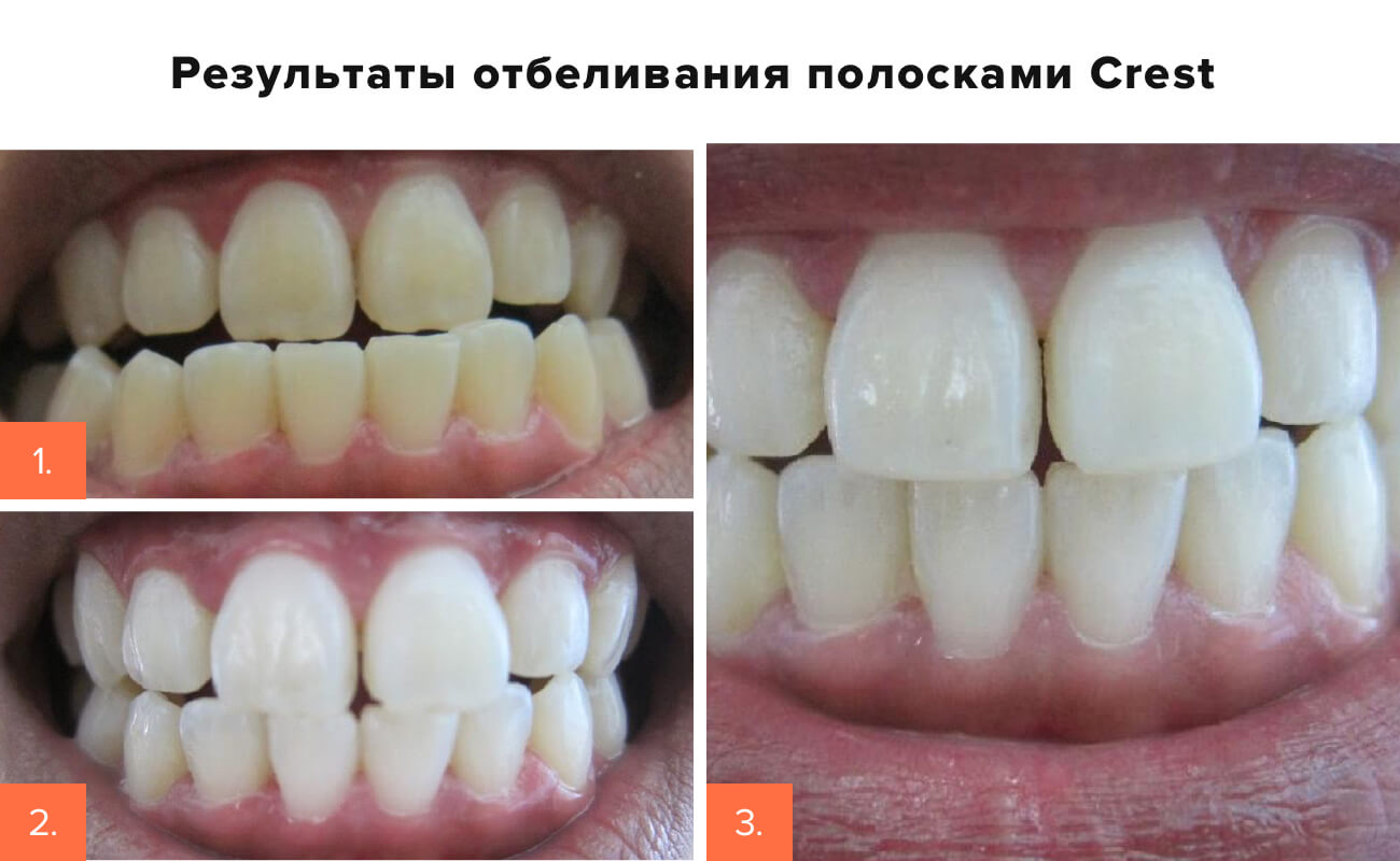 лучшие системы для домашнего отбеливания зубов. Смотреть фото лучшие системы для домашнего отбеливания зубов. Смотреть картинку лучшие системы для домашнего отбеливания зубов. Картинка про лучшие системы для домашнего отбеливания зубов. Фото лучшие системы для домашнего отбеливания зубов