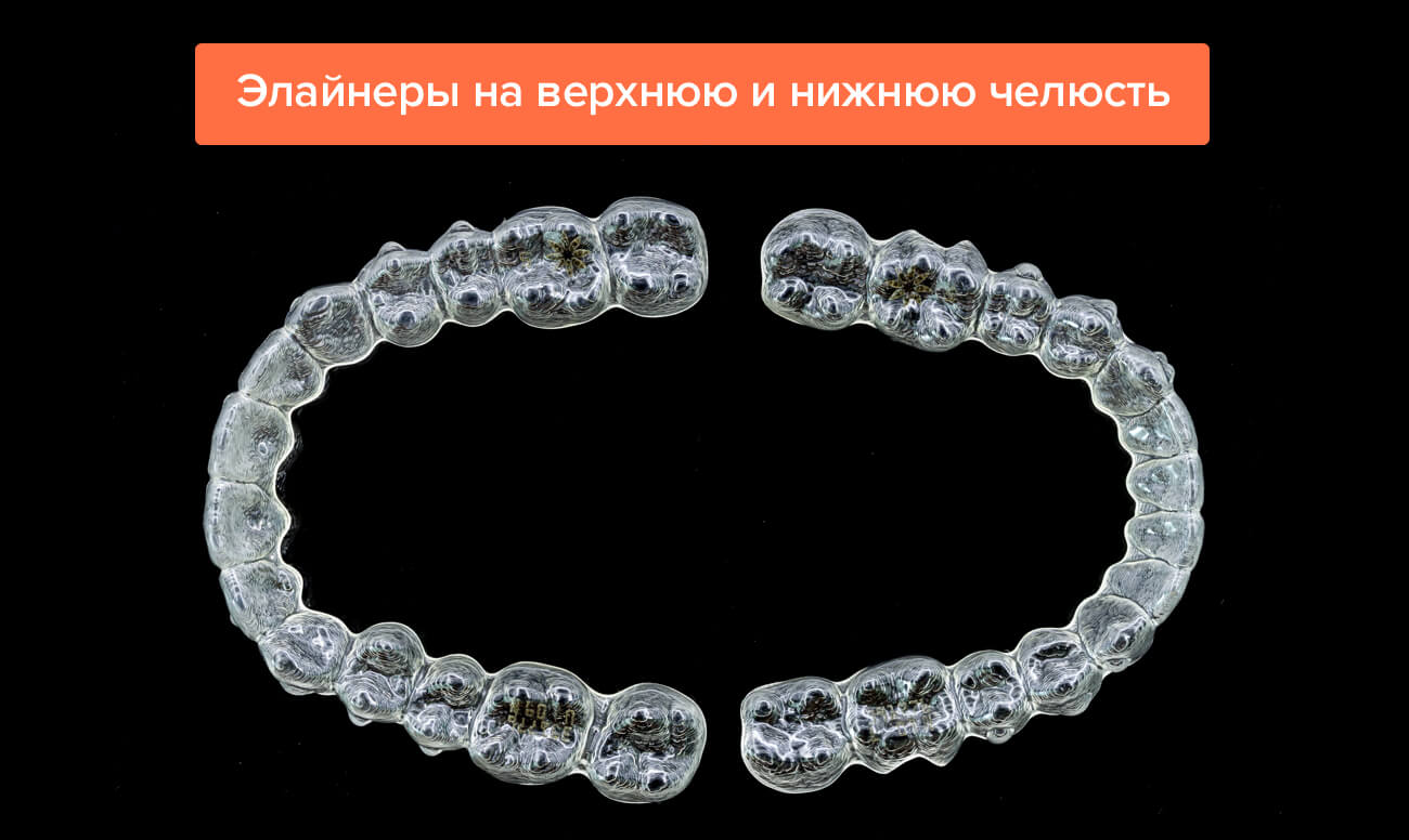 Элайнеры на верхнюю и нижнюю челюсть Фото элайнеров на верхнюю и нижнюю челюсть