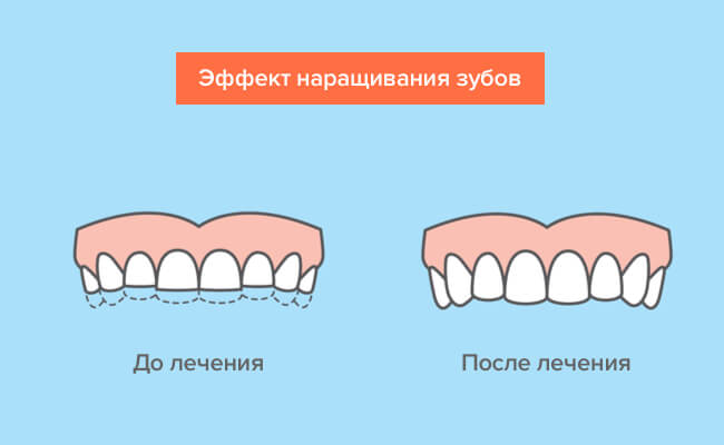 Эффект от наращивания зубов в картинках