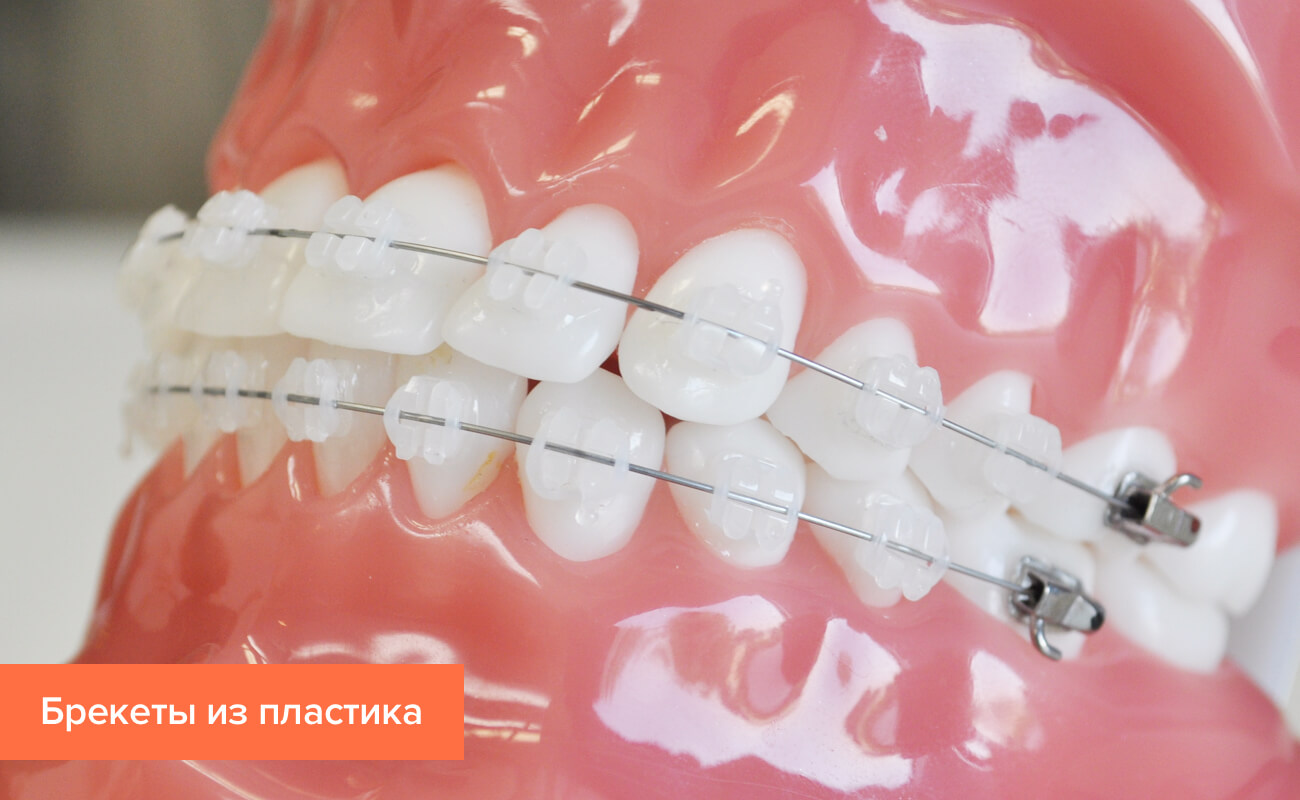 Фото эстетичных пластиковых брекетов на зубах