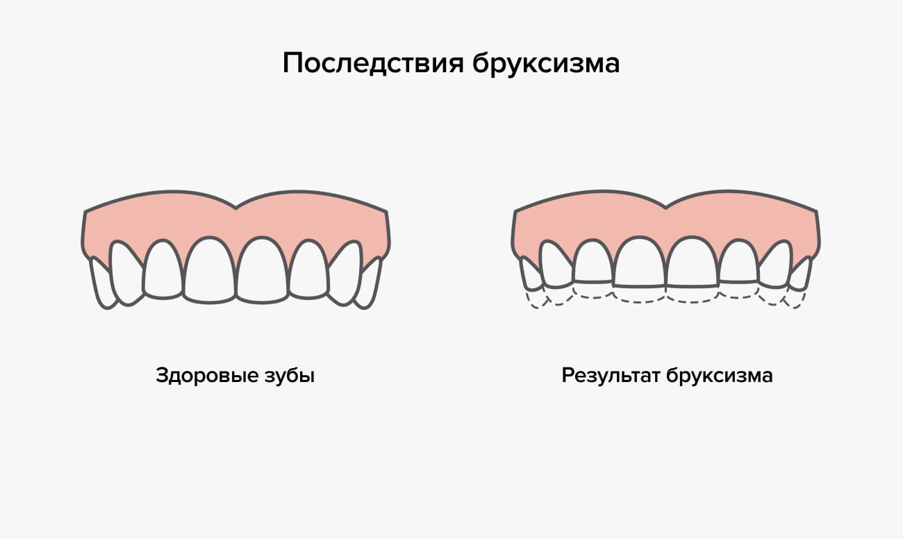 Последствия бруксизма Последствия бруксизма в картинках