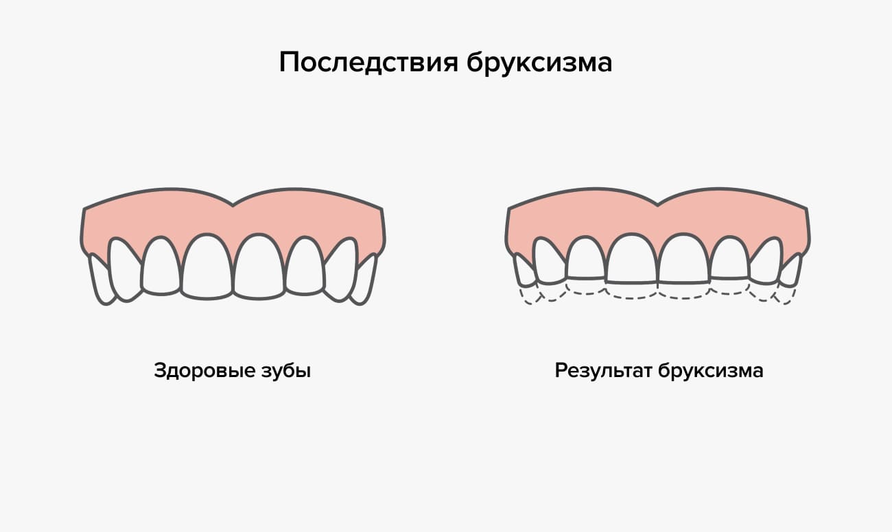 Последствия бруксизма в картинках