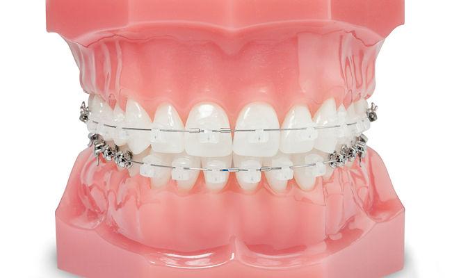 Прозрачные керамические брекеты на зубах