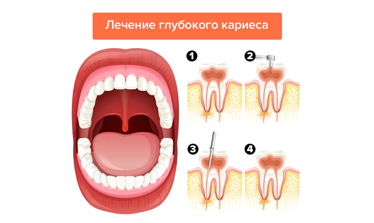 Лечение глубокого кариеса в картинках