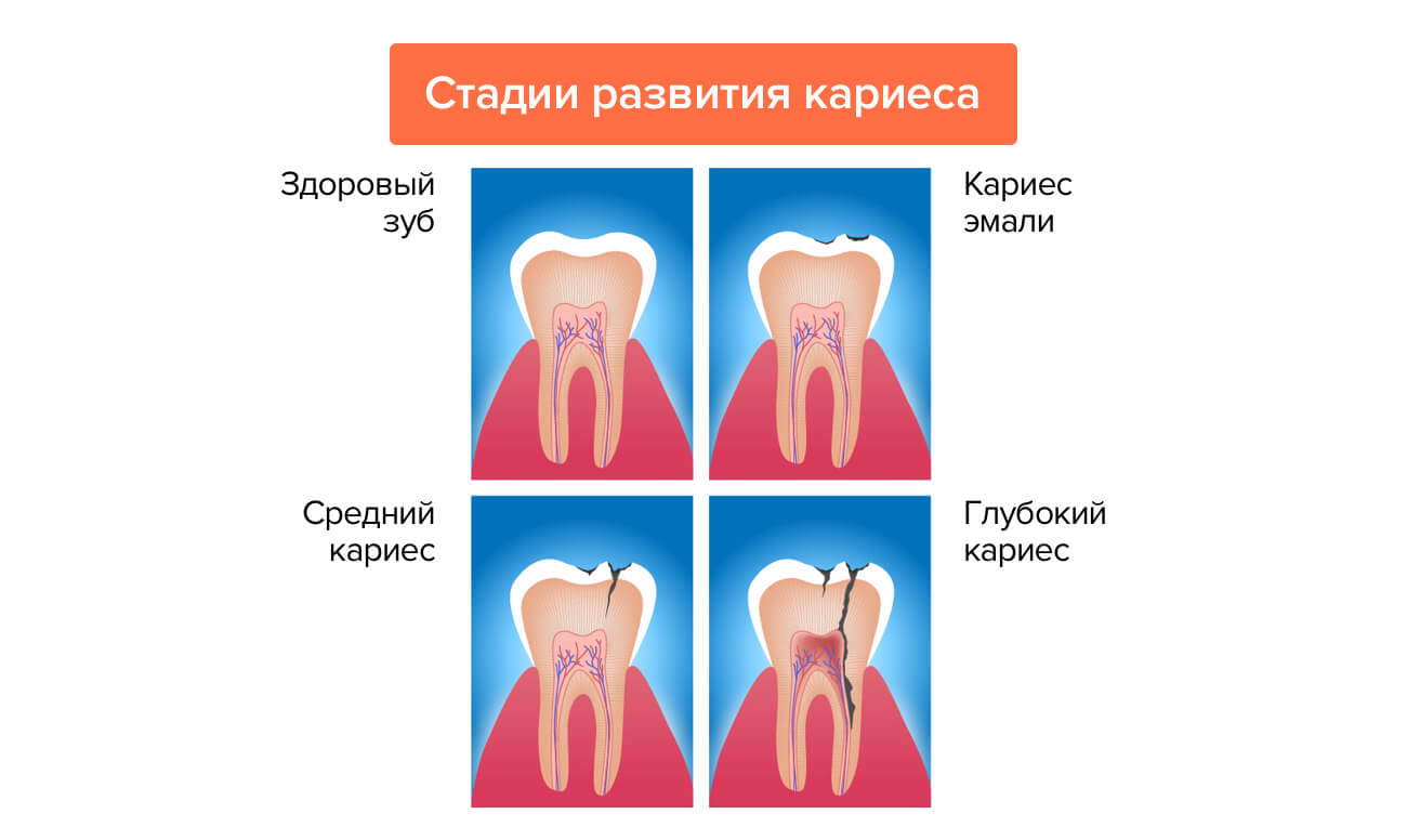 Стадии развития кариеса в картинках