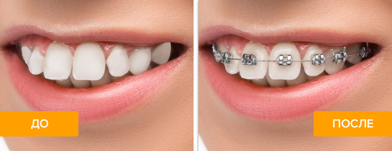 Фото до и после установки брекетов на зубы