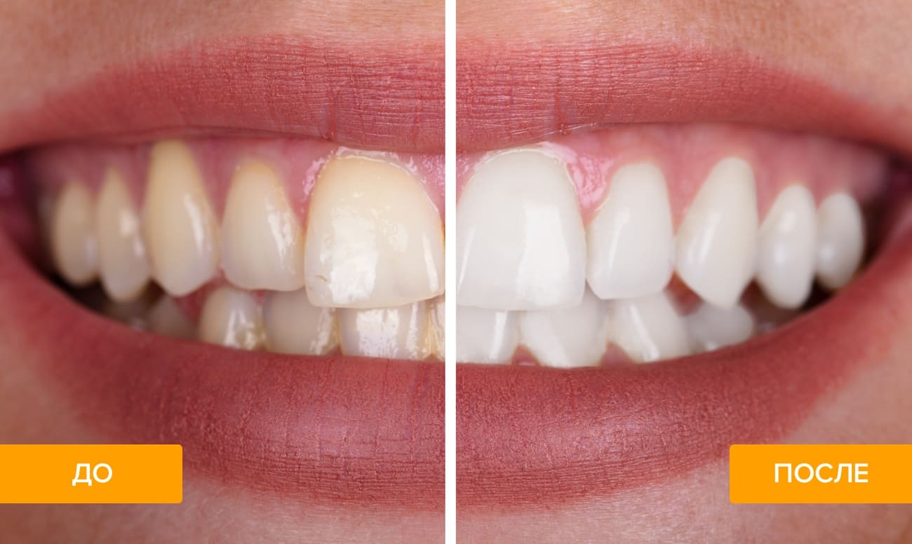 Фото зубов до и после отбеливания Zoom 3