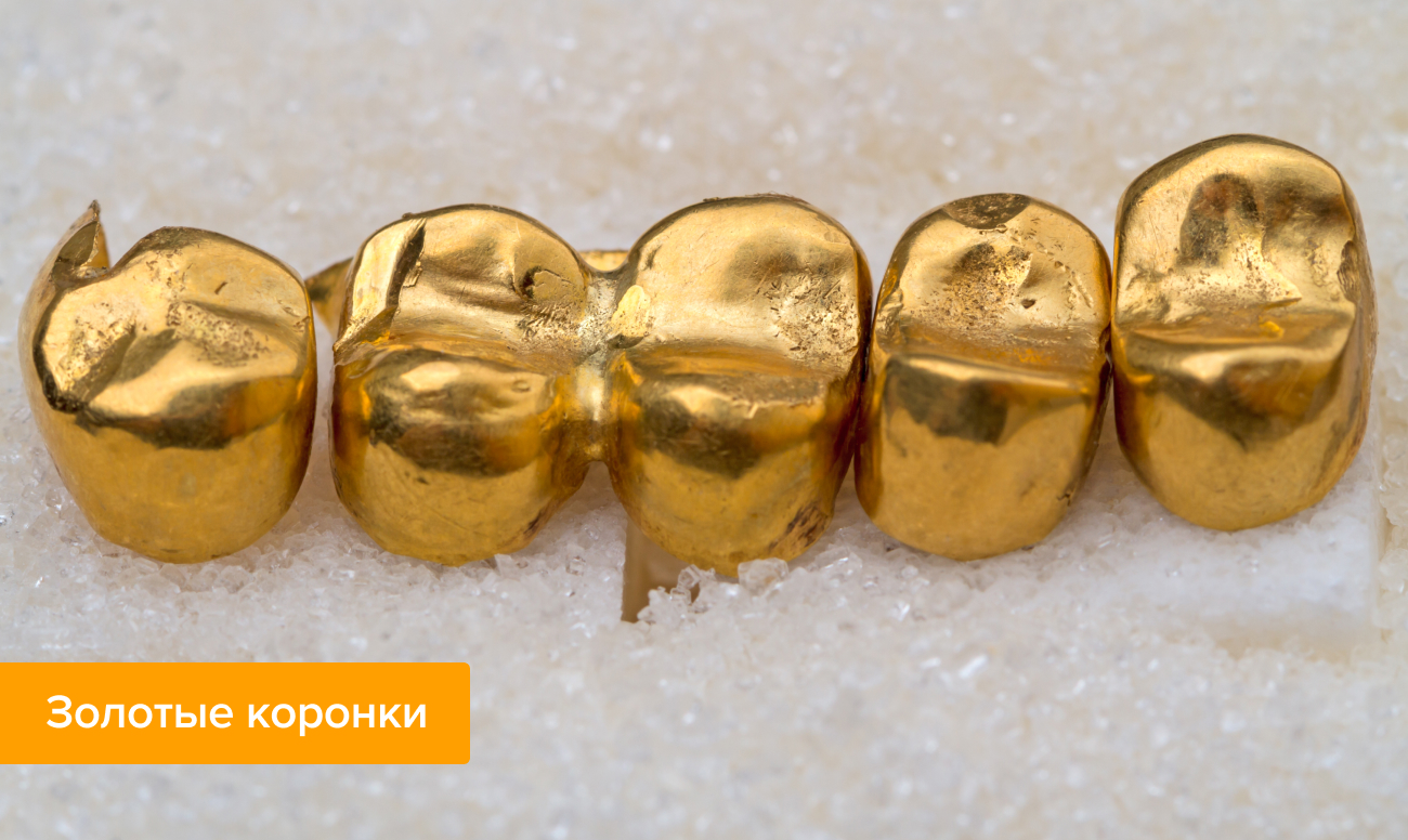 Фото коронки на зуб из золота